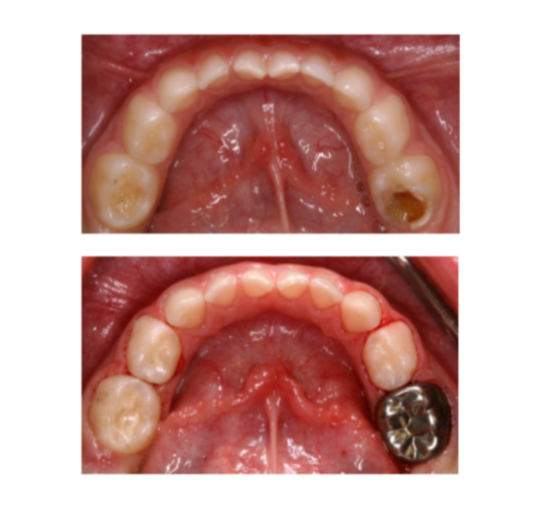 dental crown case